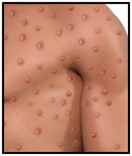 Is Monkeypox Next?